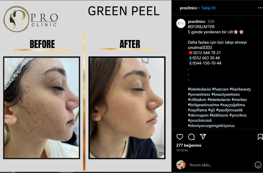 Pro Clinic firmasına ait Instagram sayfasında green peel ürünü öncesi ve sonrasını gösteren paylaşım